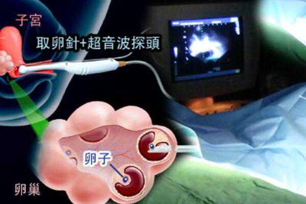 北京何处有代孕小孩|南平三代试管能避免胎停吗？