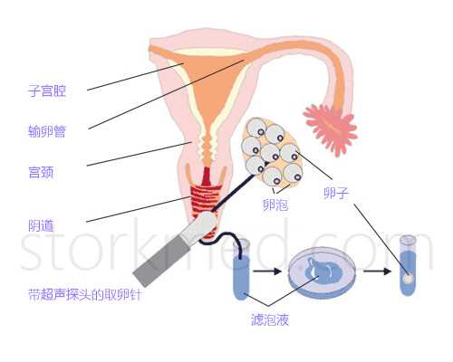 【拔罐减肥】拔火罐减肥，拔罐减肥有效吗，拔罐减肥穴位图